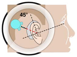 Existe distância suficiente entre a parte proximal do receptor do implante e a parede posterior do canal auditivo, para que o implante e o processador não fiquem sobrepostos.