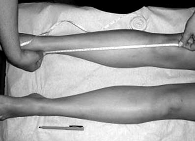 clínica do comprimento da coxa Figura 2 Técnica da mensuração clínica do comprimento da perna caso a diferença encontrada foi em média de 6 cm, o que pode ser explicado pelos diferentes pontos de