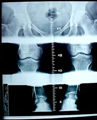 Levando-se em conta que na primeira o parâmetro é o bordo superior da patela e no segundo o côndilo femoral, a diferença pode representar a distância que existe entre os dois, que não foi avaliada