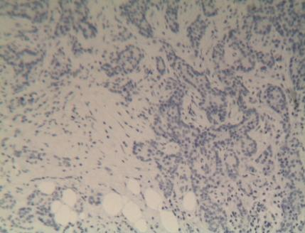 Receptor de Andrógeno Pontuação (Escore-H) [1 x (% células 1+) + 2 x (% células 2+) + 3 x (% células 3+)] Pontuação de 0 300 é calculada para cada amostra de tumor de cada paciente