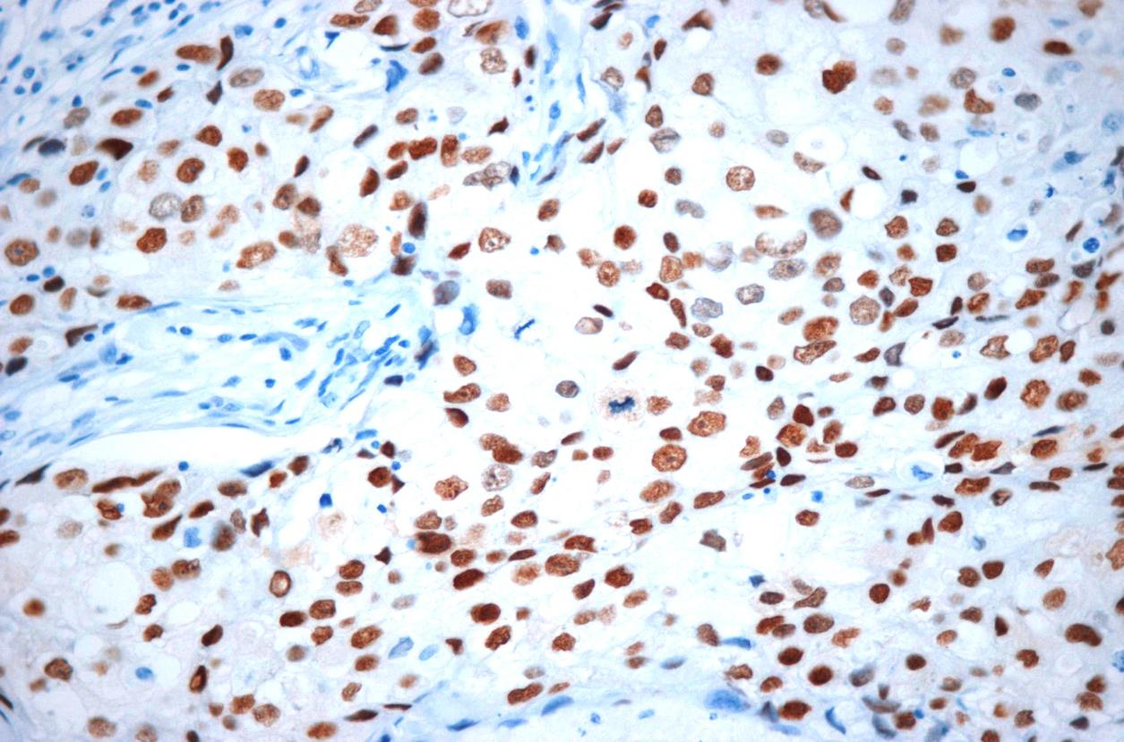 93 Figure 2 - Immunostaining of a positive androgen receptor expression in a triplenegative