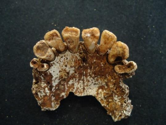 Figura 57 Exemplo de desgaste dentário oclusal no maxilar da sepultura 6 (101), variando do grau 2 ao 7.