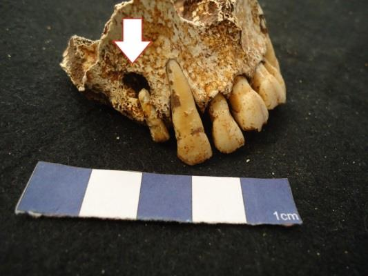 Figura 61 Quisto periapical no 1º pré molar direito do indivíduo da sepultura 6 (101). Figura 62 Granuloma no canino esquerdo e um abcesso no 1º pré molar esquerdo do indivíduo da sepultura 6 (101).