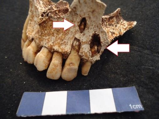 Na Serra de Carnaxide apenas o indivíduo proveniente da sepultura 3 (92), apresenta perda de dentes ante mortem, com um total de 5 dentes perdidos no lado esquerdo da mandíbula, nomeadamente o