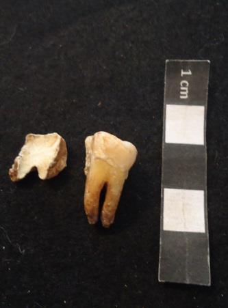A hipercementose 26 tem uma etiologia desconhecida, no entanto, pensa-se que pode estar associado a desgaste dentário e a má oclusão, devido ao seu aparecimento em dentes não erupcionados (Hillson,