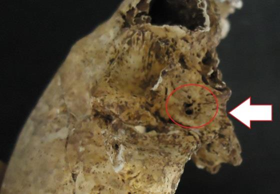 No indivíduo da sepultura 3 (93), na zona articular da mandíbula com o temporal é possível observar uma artrose, definida como artrose temporo-mandibular no lado esquerdo da articulação.
