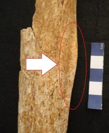 Figura 66 Artrose temporo-mandibular afetando o lado esquerdo da articulação, da sepultura 3 (93). Na tíbia direita, da sepultura 4 (91A), é observável uma lesão de possível origem traumática.