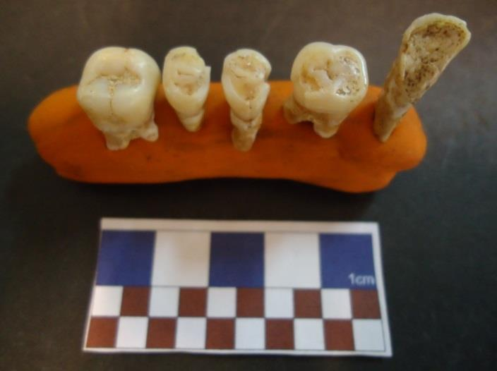 4.1.4.4 Patologia oral 4.1.4.5 Desgaste dentário Na presente dissertação foram contabilizados, para o Casal de São Brás, um total de 215 dentes, dos quais apenas um foi classificado como não