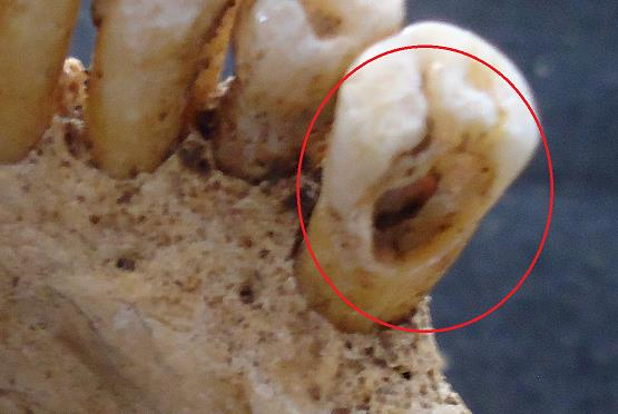 Figura 25 - Cárie no 2º pré molar inferior direito correspondente à sepultura 4, com tamanho 2 e origem na zona interproximal. 4.1.4.7 Tártaro dentário O tártaro dentário foi observado macroscopicamente.