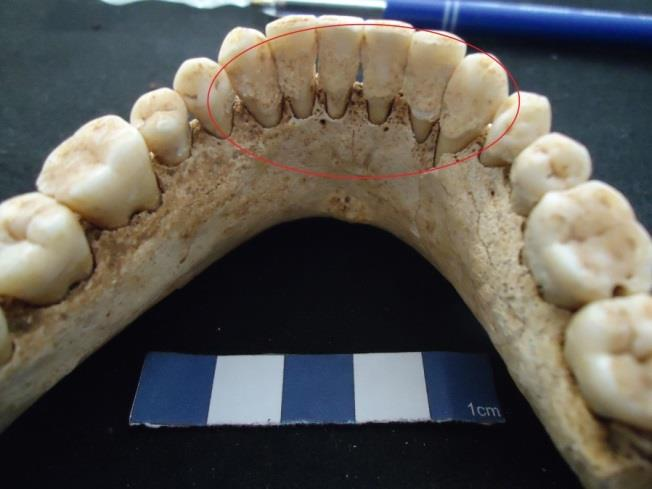 Figura 26 Sepultura 5 com tártaro dentário na superfície bucal dos dentes da mandíbula, estando expostos os graus 2,3 e 4.