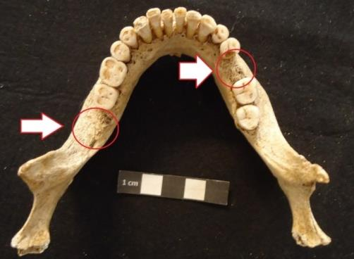 A mandíbula afetada pertence ao indivíduo da sepultura 5 (sexo masculino, adolescente), sendo bilateral a lesão nas zonas dos pré-molares e no molar (ver figura 28).