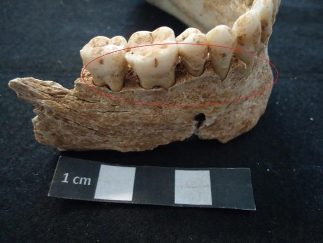 1.4.9 Perda ante mortem Na perda ante mortem foram tidos em conta todas as mandíbulas e maxilares preservados da amostra, tendo sido considerados perdidos os dentes ante mortem quando havia a