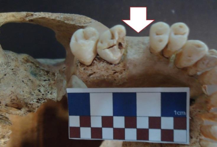 No entanto, nesta última sepultura, também pode haver um caso de perda ante mortem do 1º molar direito maxilar, mas devido a uma pasta aplicada ao crânio, pela equipa de escavação, o alvéolo