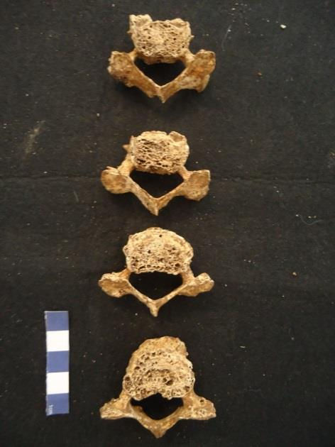 Figura 52 Exemplo de lipping+porosidade nas vértebras cervicais da sepultura 4 (89).