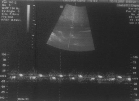 Fig. 4. Reversão da taquicardia supraventricular pós tratamento com digoxina. Ritmo sinusal e BCF de 123 bpm. VI.