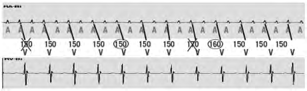 A freqüência ventricular é menor do que a freqüência atrial (V < A) As freqüências ventricular e atrial são iguais (V = A) A freqüência ventricular é maior do que freqüência atrial (V > A) Figura 1 -