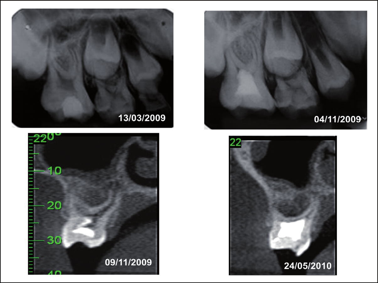 Controle radiográfico do fechamento da raiz