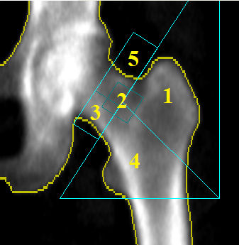 Regiões anatómicas do fémur: 1 Trocânter; 2 Área de Ward; 3-5 Colo do fémur; 4 diáfise. Regiões da coluna, vértebras: L1, L2, L3 e L4.