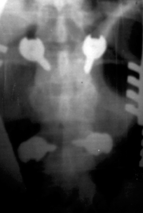 300 Vecina E, Rusconi CAM, Miras JF, Maito Z Figura 4 Radiografia em incidência pôstero-anterior da coluna lombar, feita como controle do posicionamento dos implantes recentemente colocados por
