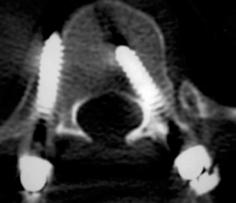 Análise tomográfica do posicionamento de parafusos pediculares 301 po vertebral.