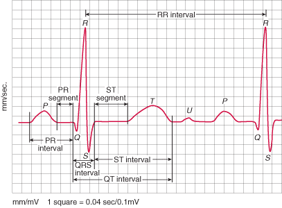 Voltagens anormais do complexo QRS No coração saudável as d.d.p., nas derivações bipolares dos membros, entre o pico da onda R e o pico da onda S são da ordem dos 0.