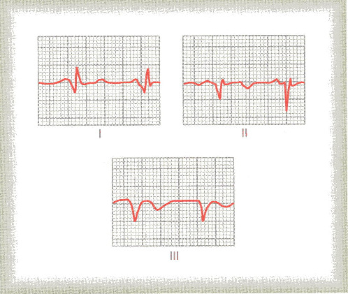 Voltagens anormais do complexo QRS Uma das causas mais comuns para baixa voltagem no complexo QRS é um ou mais enfartes do miocárdio (enfarte significa: lesão necrótica circunscrita de um órgão em