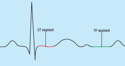 Desnivelamento do segmento ST Como vimos, a presença duma corrente de lesão provoca um desnivelamento do segmento TP.