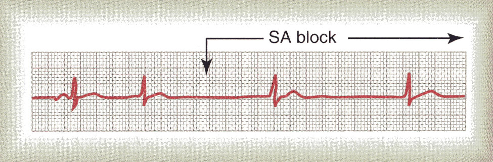Bloqueio dos sinais cardíacos nas vias de condução intracardíacas O bloqueio sinoauricular deve-se a um bloqueio na saída do impulso do nó sinusal.