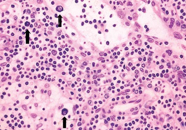 Os mielócitos e os mastócitos, num exame superficial, podem assemelhar-se aos plasmócitos.
