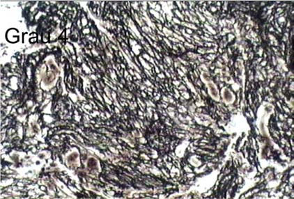 A quantidade do tecido hematopoético é expressa como porcentagem aproximada em relação ao tecido adiposo dentro da cavidade medular. Princípios de técnicas especiais Figura 14.