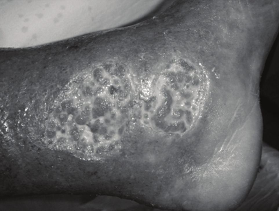 Observou-se um predomínio de 7,66% de bastonetes gram-negativos isolados das lesões de membros inferiores. No pé diabético, a espécie mais freqüente foi Staphylococcus aureus, seguida pela E.