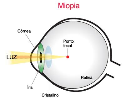 Aplicação do Laser para correção de miopia Miopia Curvatura da córnea