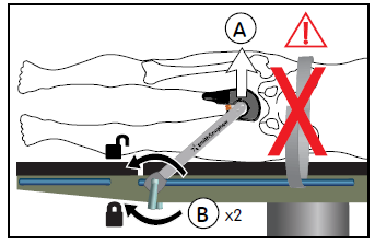 Página 7 Figura 3 6. Prenda a barra do distrator à estrutura lateral (Figura 4-A). 7. Aperte o botão de fecho do distrator (Figura 4-B).