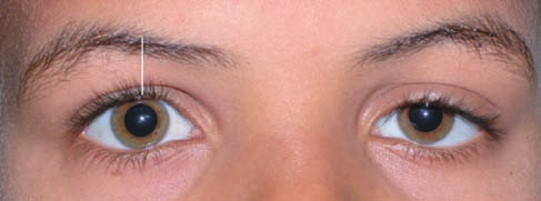 Ptose palpebral: avaliação do posicionamento palpebral por imagens digitais 19 ABSTRACT Objectives: To assess the palpebral position in patients with congenital or acquired ptosis, related to margin,