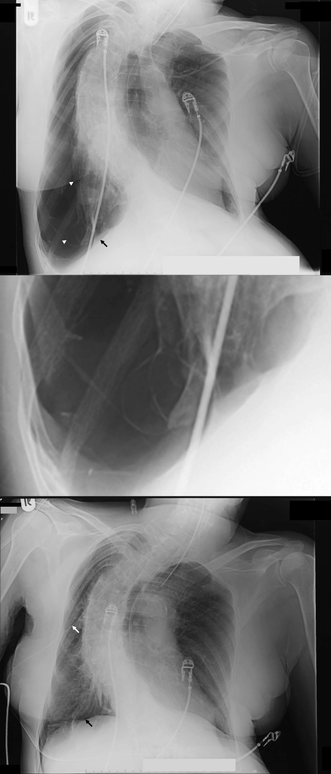 Pneumotórax como complicação associada ao recrutamento do volume pulmonar A B C Figura 1 - Em A, radiografia de tórax na internação demonstrando pneumotórax do lado direito.