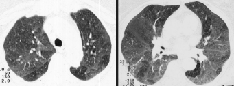 ronquiolite constritiva: aspectos tomográficos e correlação anatomopatológica SUÍSTI E MÉTODOS No período compreendido entre 1999 e 2001, foram atendidas três pacientes do sexo feminino, com idades