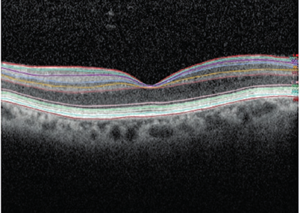 Análise das camadas retinianas em doentes com lesão isquémica da artéria cerebral posterior unilateral: Um estudo de tomografia de coerência óptica ocular e/ou evidência de outras patologias