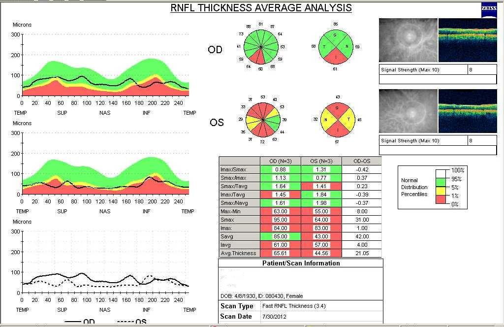 28 Figura 3 Impresso da análise da CFNR peripapilar pelo Stratus OCT 3 Análise Estatística Adotou-se o teste t pareado para comparar os valores da espessura da CFNR antes e após a trabeculectomia.
