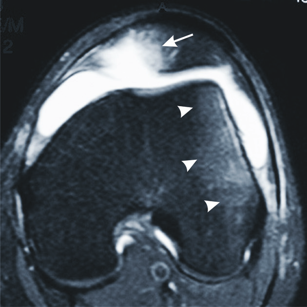 160 Rev Bras Ortop. 2013;48(2):159-164 Patellofemoral instability: evaluation by magnetic resonance imaging abstract Keywords: Joint Instability; Patellar Dislocation; Magnetic Resonance Imaging.