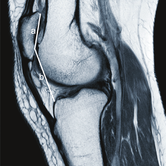 Rev Bras Ortop. 2013;48(2):159-164 161 lesões tendíneas, ligamentares, meniscais ou cartilaginosas.