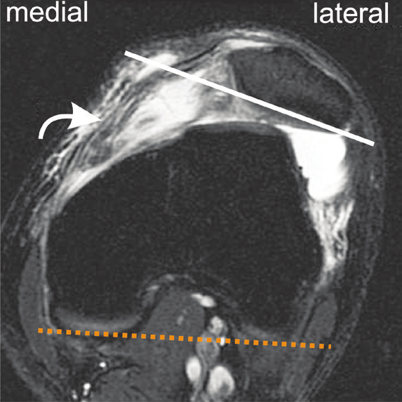 Tipo C facetas trocleares assimétricas, com hipoplasia da faceta medial e convexidade da faceta lateral.