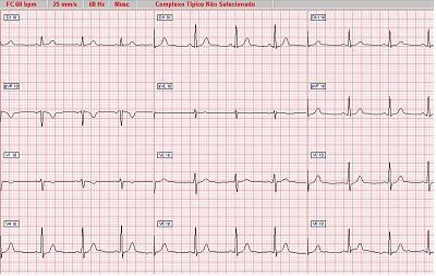 Distúrbios eletrocardiográficos Alterações nos padrões normais da atividade elétrica do coração costumam ser