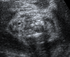 Revisão de Literatura C Tr C Figura 6 - Imagem ultra-sonográfica da tireóide fetal em corte