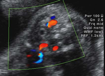 C Tr C Figura 7 - Imagem ultra-sonográfica da tireóide fetal em corte transversal do pescoço fetal,