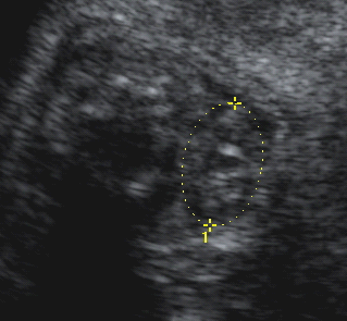 Figura 11 - Medida do perímetro e da área da tireóide fetal em corte transversal do
