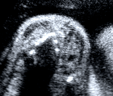 Métodos C T Figura 16 Corte transversal do pescoço fetal mostrando a tireóide fetal
