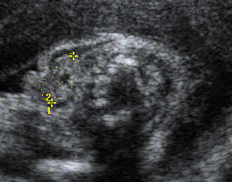 Métodos Figura 18 - Corte transversal do pescoço fetal mostrando o diâmetro transverso, perímetro e área da