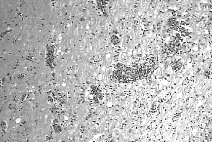 Cerebelo Desmielinização multifocal intensa da substância branca, pequenos manguitos perivasculares formados por uma a duas camadas de células mononucleadas, pequenas áreas de necrose da substância