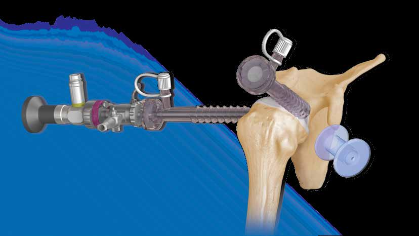 Estabilização de luxações agudas da articulação acromioclavicular com a tecnologia Dog Bone Button O Dog Bone Button é um botão pré-moldado de titânio que permite o uso de várias FiberTapes para