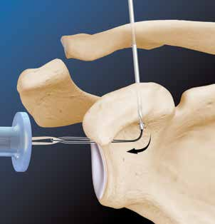 1 2 Pelo portal anterior baixo, coloque a guia AC adequada* sob a base do coracoide e perfure túneis na clavícula e no coracoide, usando a broca canulada de 2,4 mm ou